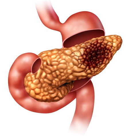 In the vast majority of cases, symptoms only develop after pancreatic cancer has grown and begun to spread. Doctors Discover Why Pancreatic Cancer Kills So Quickly ...