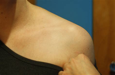 Dislocated Left Collar Bone Photo Taken By Fiance Flickr