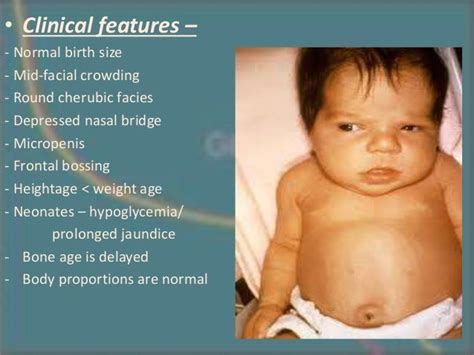 Cherubic Facies Is Seen In Fibro Osseous Lesion Also Seen In Glycogenosis Particularly Type Ii
