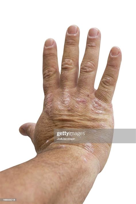 Psoriasis On A Mid Age Mans Right Hand High Res Stock Photo Getty Images