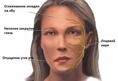 Диета при невралгии тройничного нерва Невралгия тройничного нерва - симптомы и лечение в Казани Невралгия тройничного нерва - симптомы и лечение в Казани Диета при невралгии тройничного нерва