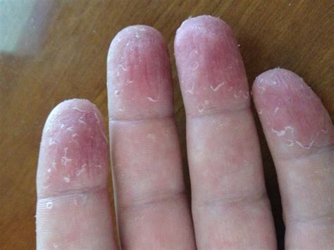 Top 12 Tips For Peeling Skin On Hands Palms And Fingertips