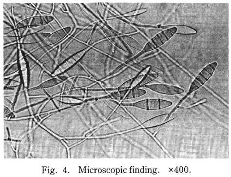 Figure 4 From A Case Of Tinea Scroti Due To Microsporum Gypseum