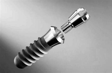 Titanium Teeth The Nuts And Bolts Of Dental Implants World Newsstand