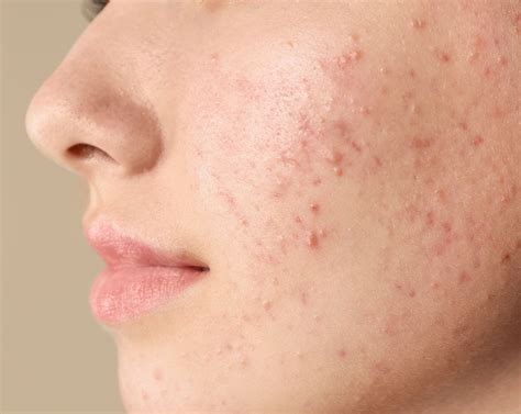Qué es el acné y cómo ayudar a combatirlo NIVEA