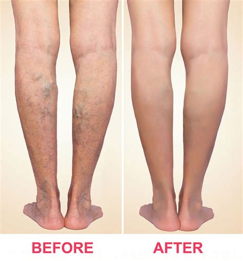 Endovenous Laser Therapy Evlt The Vein Institute And Medispa