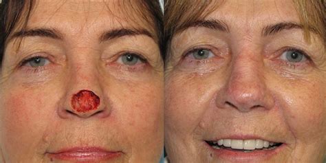 Nose Reconstruction After Skin Cancer Excision Skin Cancer And Reconstructive Surgery Center