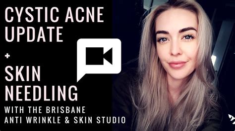 Cystic Acne Treatment Skin Needling My Skin Update Youtube