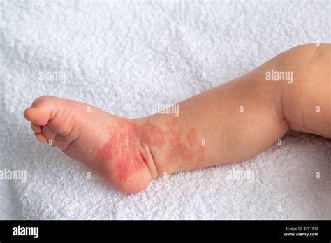 Hemangioma Red Birthmark On The Leg Of Newborn Baby Stock Photo Alamy