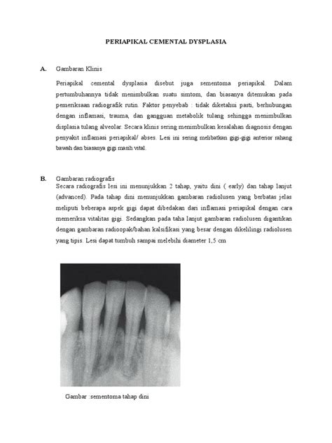 Serum carotenoids and vitamins and risk of cervical dysplasia. Periapikal Cemental Dysplasia