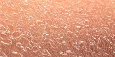 What Could Be Causing Your Dry Skin Delta 5