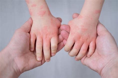 Mengenali Tanda Dermatitis Atopik Pada Orang Dewasa Dan Anak Anak