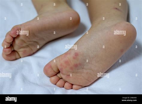 Allergic Rash Skin Of Babys Right Foot Hand Foot And Mouth Disease