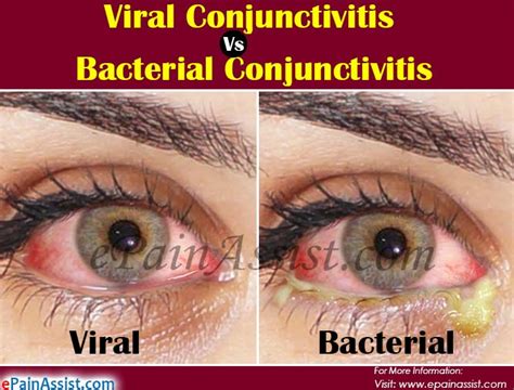 Difference Between Viral Pink Eye And Bacterial Pink Eye Global Treatment Services Pvt Ltd