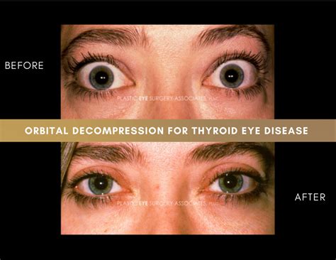 Hyperthyroidism Eyes Before And After