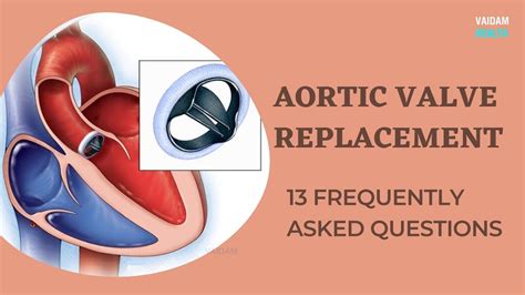 Aortic Valve Replacement 13 Frequently Asked Questions Youtube