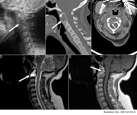 Giant Cell Tumor Of The Spine A Rare Cause Of Cervical Pain