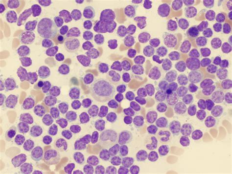 Medical Pictures Info Acute Lymphoblastic Leukemia