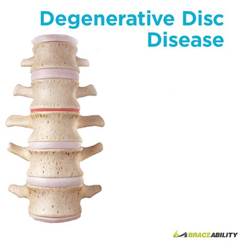 Degenerative Disc Disease Osteoarthritis Causes Symptoms And Treatment