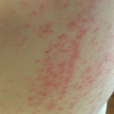 Groin Rash