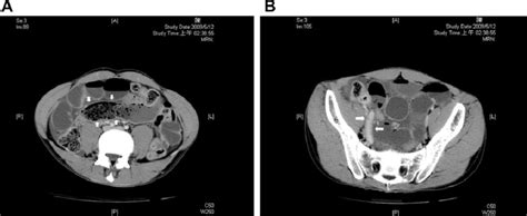 A Contrast Enhanced Abdominal Computer Tomography Ct Revealed