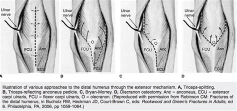 Distal Humerus Fractures Trauma Orthobullets