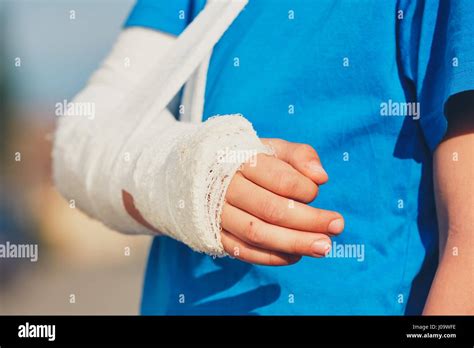 Broken Hand Fotografías E Imágenes De Alta Resolución Alamy