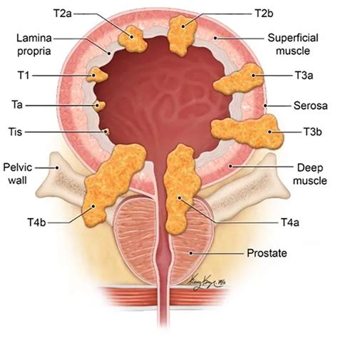 Urinary Bladder Cancer Types Stages Symptoms Causes And Tests Ganesh Diagnostic