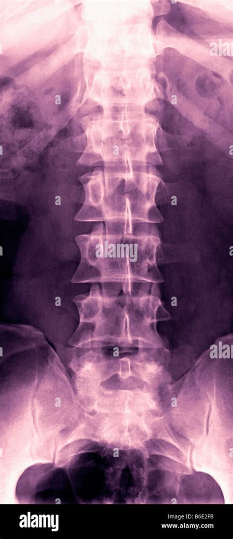 Normal Lumbar Spine Coloured Frontal X Rayshowing Bones Of The Lower