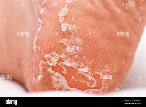 Skin Peeling On The Sole Of A Foot Stock Photo Alamy