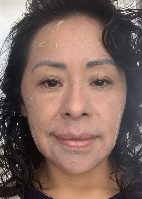 Chemical Peel Before After Photos Fresh Face Eye