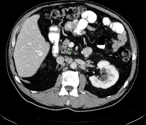 Computed Tomography Scan Before Atezolizumab Treatment Initiation