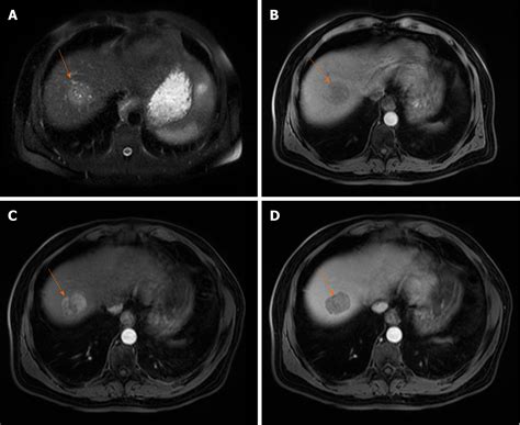 Pearls And Pitfalls In Magnetic Resonance Imaging Of Hepatocellular
