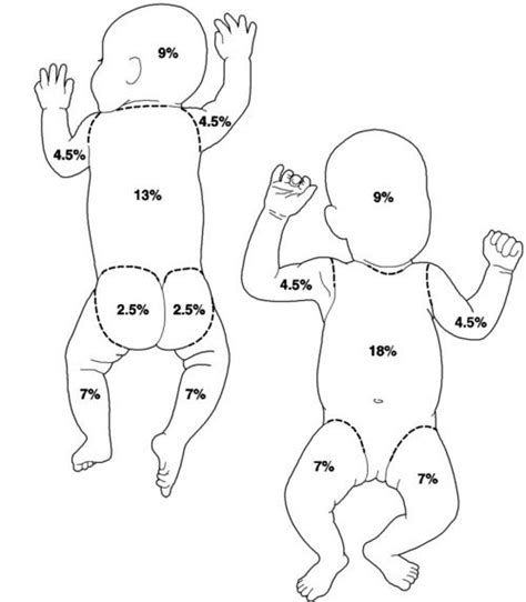 Burn Classification For Infants Lund And Browder Burns Nursing