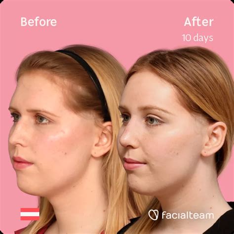 Sarah M Before And After Ffs Surgery — Facialteam