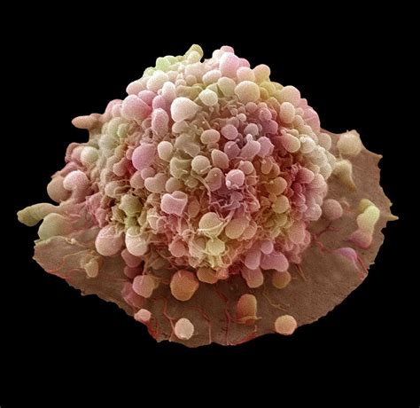 Cervical Cancer Cell Photograph By Steve Gschmeissner Fine Art America