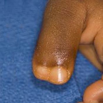 Polydactyly Extra Fingers Or Toes And Corrective Surgery HSS