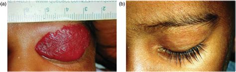 A The Capillary Hemangioma Of The Left Upper Lid B The Complete