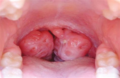 Swollen Tonsils Symptoms Causes Treatment Remedies With White