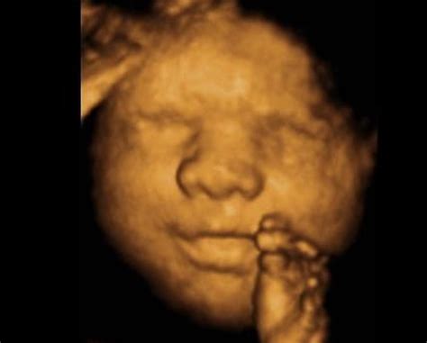 Deal 50 For 3d4d Ultrasound Plus Gender Determination With Bella