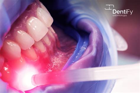 Laserterapia Dentify Odontologia