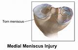 Images of Medial Meniscus Tear Therapy