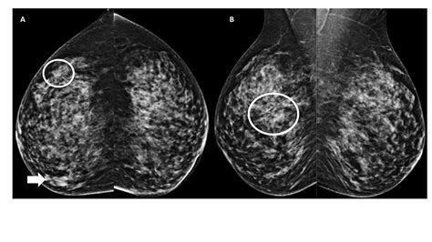 Cureus Effectiveness Of Tomosynthesis Versus Digital Mammography In