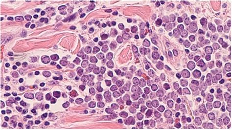 New Study Provides A Better Understanding Of Merkel Cell Carcinoma