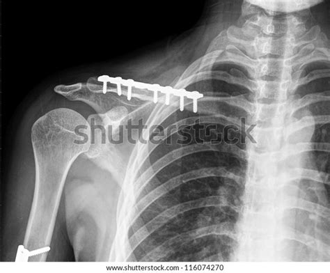 X Ray Collarbone Stock Photo 116074270 Shutterstock