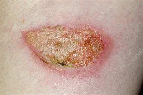 Infected Burn On The Arm Stock Image C0167242 Science Photo Library