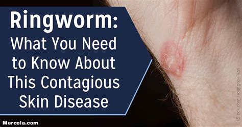 Ringworm In Adults