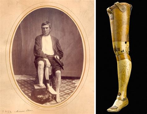 The Fascinating Untold History Of War And Prosthetics Gizmodo Australia