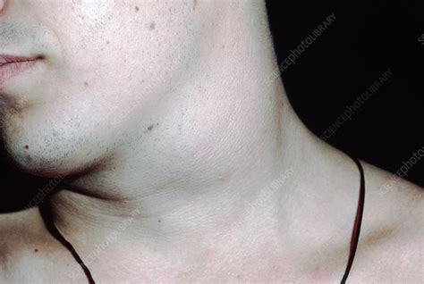 Branchial Cyst On Neck Of 18 Year Old Man Stock Image M1300350