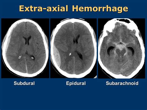 Epidural Hematoma Vs Subdural Hematoma Vs Subarachnoid Hemorrhage